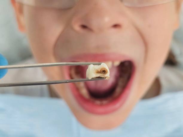 Best Broken or Chipped Tooth Repair in Blanding, UT